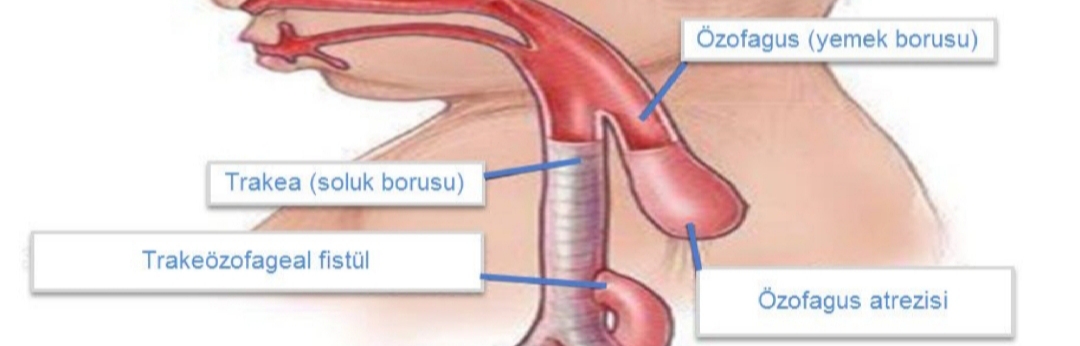 Yeni doğan kız çocuğuna yapay yemek borusu yapıldı.